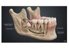 Wisdom Tooth Removal Near Me for Expert Dental Care 