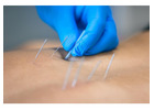 Acupuncture in Singapore for Pain and Stress Relief 