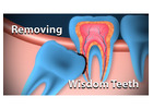 Wisdom Teeth Removal Oxenford – Comfortable Dental Care