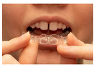 Best Aligners for Gap Teeth for a Straighter Smile