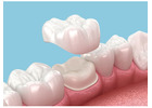 What Is a Dental Crown? Cost, Types & Benefits in Abbotsford