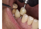 Get your natural look with metal-free Dental crowns in Tijuana from Teeth Savers