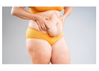 Tummy Tuck Surgery in Delhi - Dr Rajat Gupta
