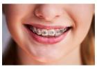 Clear Aligners & Braces Treatment by Expert Orthodontist