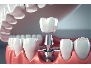 How Dental Implants in Islamabad Improve Eating Comfort How Dental Implants in Islamabad Improve Eating Comfort
