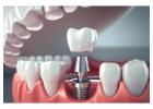 How Dental Implants in Islamabad Improve Eating Comfort