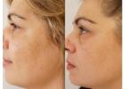 Laser For Melasma Clermont