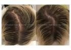 Practical Solutions for Female Hair Loss in Melbourne