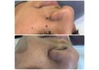 Skin tag removal clinic Goodmayes 