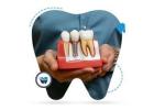 Get Affordable Dental Implants Treatment in Perth – Iluka Dental Centre