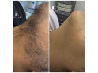 Laser hair removal east London Laser hair removal east London