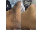 Laser hair removal east London