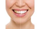 Best Teeth Whitening Melbourne for a Brighter Smile