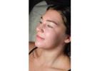 Best Acne Scar Treatment in Lambeth