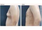 Common Side Effects and Risks of Gynecomastia Surgery