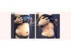 Latest Tummy Tuck Surgery Techniques Available Today
