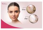 Say Goodbye to Acne – Try the Best Acne Removal Treatments in Bangalore Today!