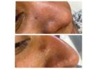 Skin tag removal clinic Goodmayes 