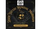 Laser Tattoo Removal Markham – Safe, Effective, and Precise Tattoo Removal