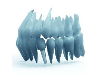 Dental Fillings in Huntington Beach, CA Dental Fillings in Huntington Beach, CA