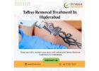 Tattoo Removal Treatment In Hyderabad | Dr. Venus
